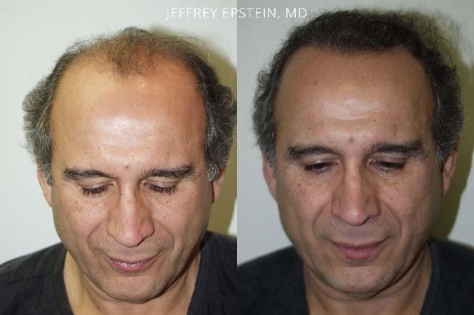 Hair Transplants for Men Before and after in Miami, FL, Paciente 38817