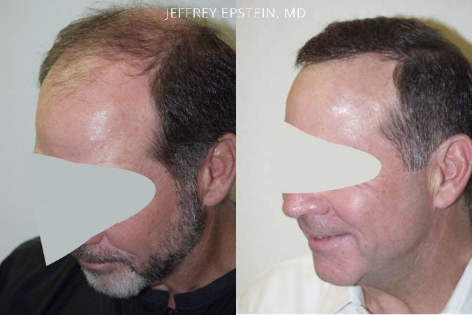 Hair Transplants for Men Before and after in Miami, FL, Paciente 38821