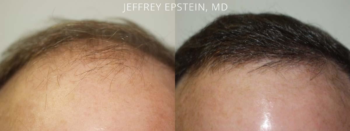Hair Transplants for Men Before and after in Miami, FL, Paciente 38821