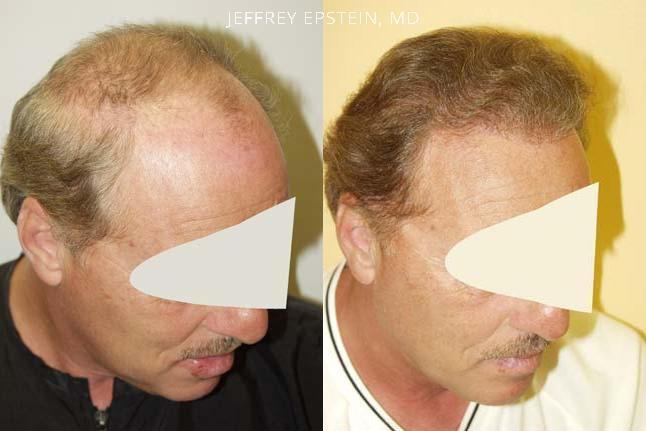 Hair Transplants for Men Before and after in Miami, FL, Paciente 38835