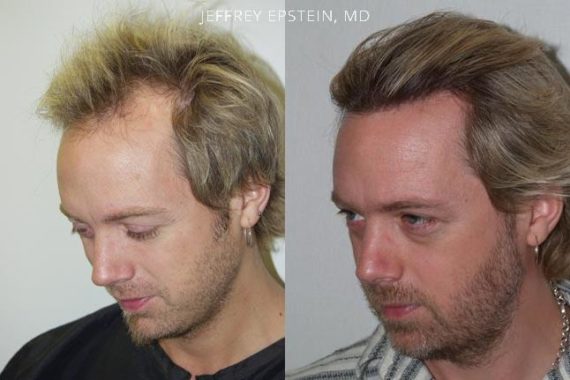 Trasplante de Pelo en Hombres Before and after in Miami, FL, Paciente 82299