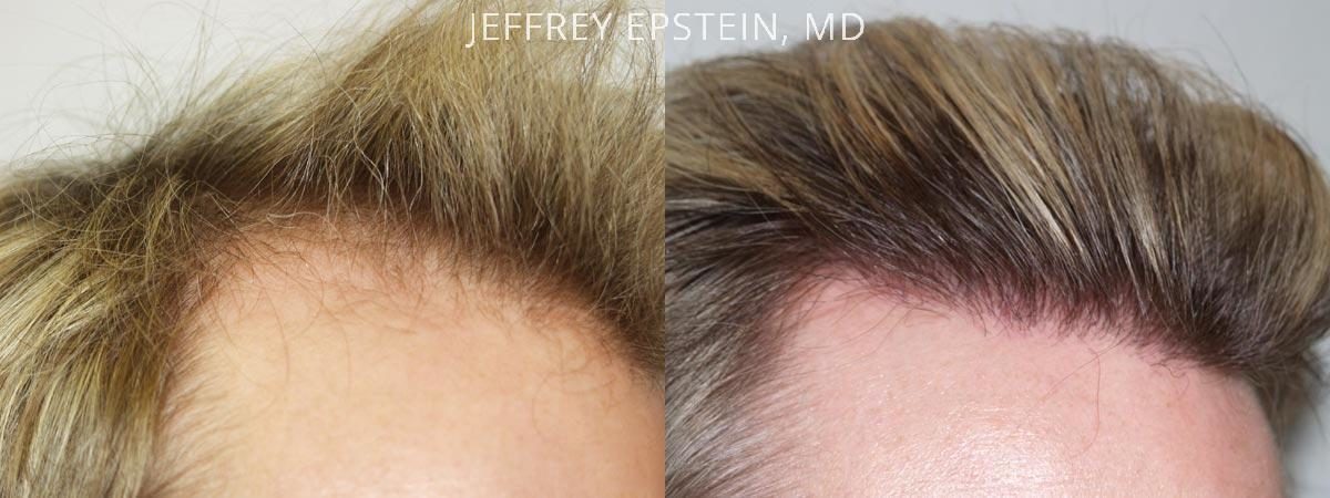 Hair Transplants for Men Before and after in Miami, FL, Paciente 38840