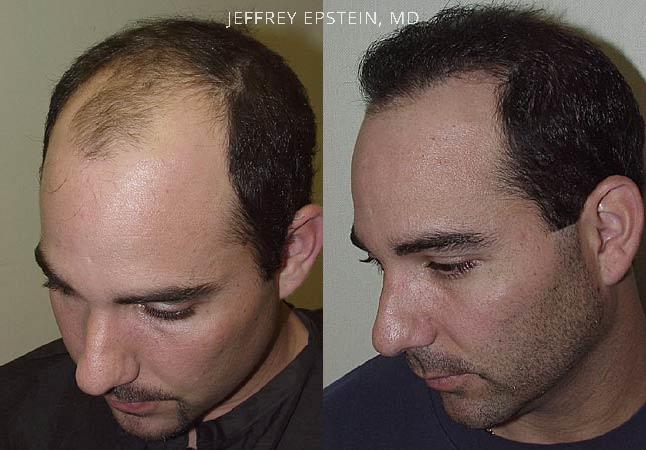 Hair Transplants for Men Before and after in Miami, FL, Paciente 38853