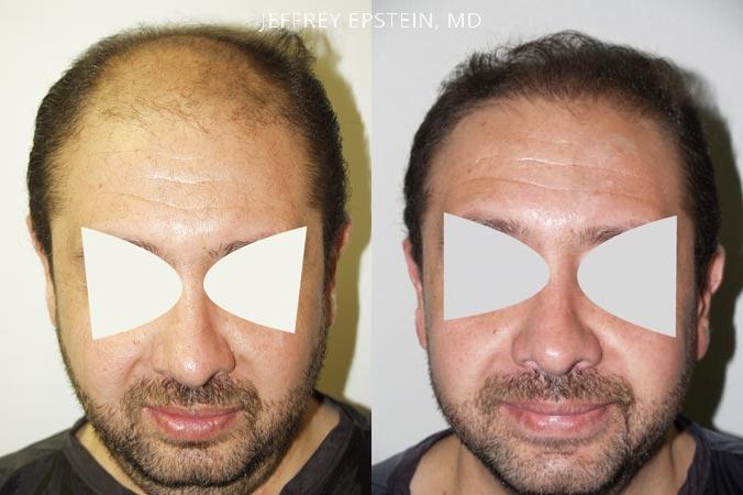 Hair Transplants for Men Before and after in Miami, FL, Paciente 38856