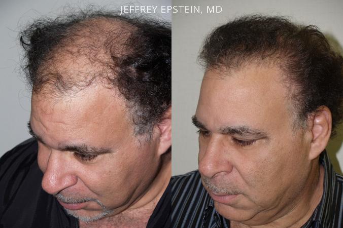 Trasplante de Pelo en Hombres Antes y después en Miami, FL, Paciente 82204
