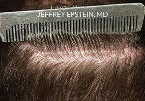 Hair Transplants for Men Before and after in Miami, FL, Paciente 38870