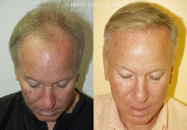 Hair Transplants for Men Before and after in Miami, FL, Paciente 38874