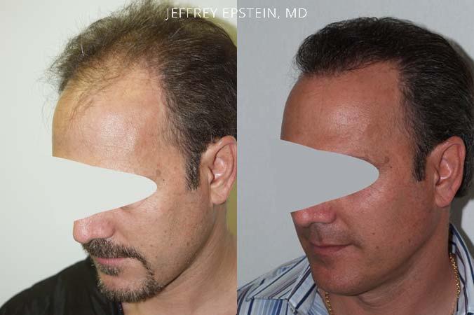 Hair Transplants for Men Before and after in Miami, FL, Paciente 38877