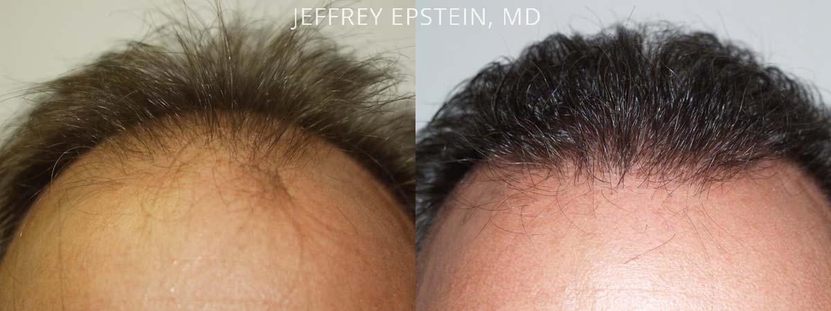 Hair Transplants for Men Before and after in Miami, FL, Paciente 38877