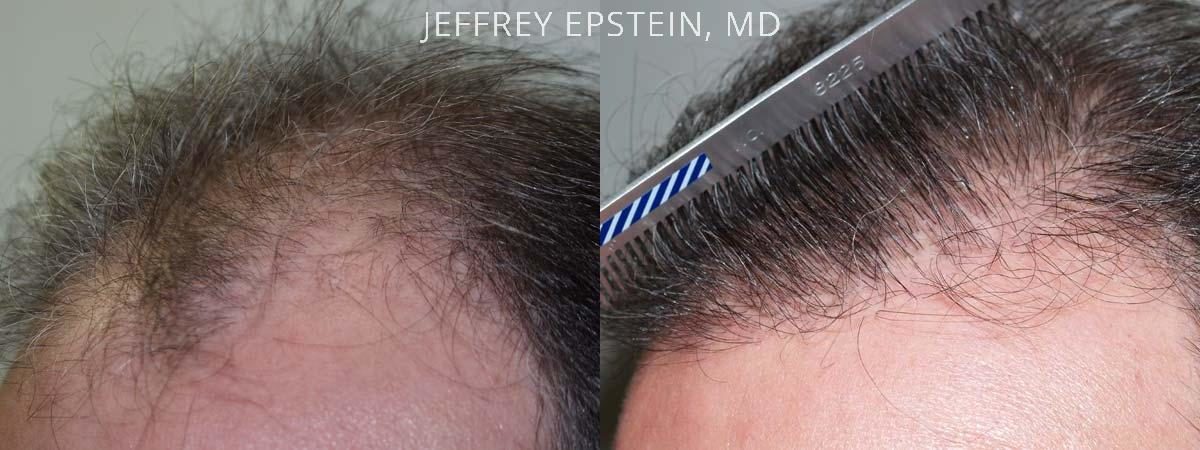 Hair Transplants for Men Before and after in Miami, FL, Paciente 38884