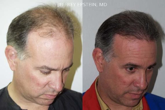 Trasplante de Pelo en Hombres Before and after in Miami, FL, Paciente 82090