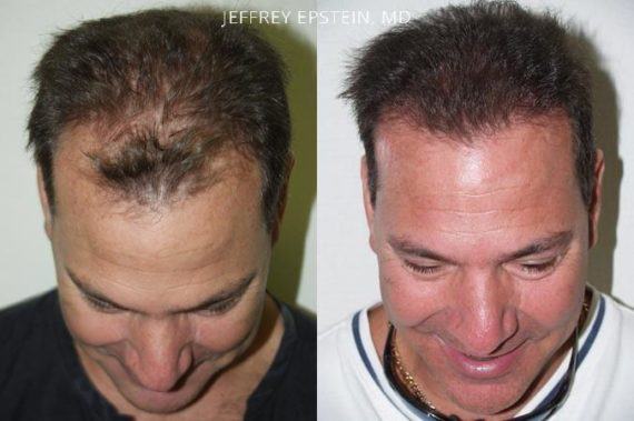 Hair Transplants for Men Before and after in Miami, FL, Paciente 38893