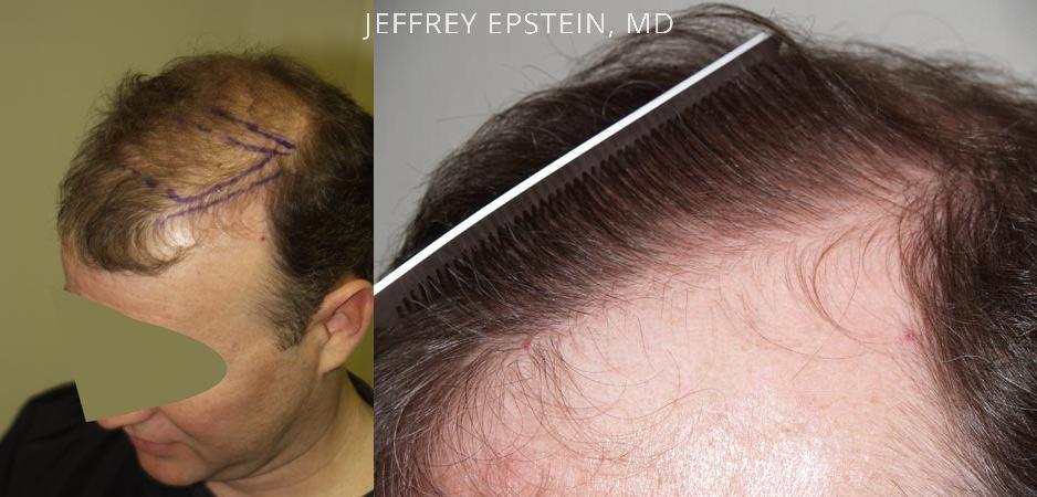 Hair Transplants for Men Before and after in Miami, FL, Paciente 38896