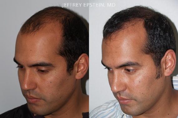 Trasplante de Pelo en Hombres Before and after in Miami, FL, Paciente 81965