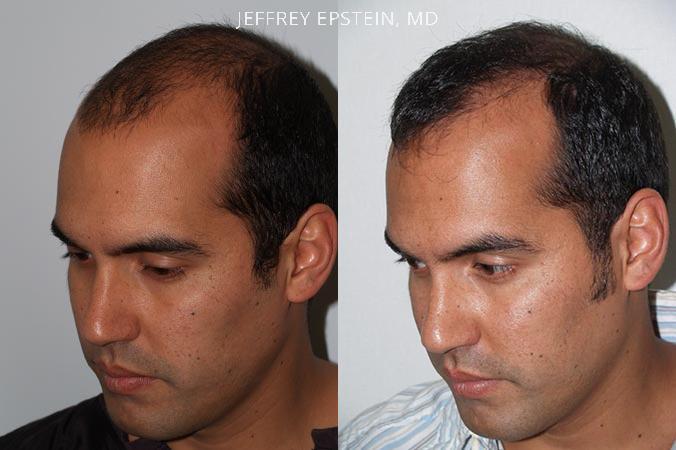 Hair Transplants for Men Before and after in Miami, FL, Paciente 38906