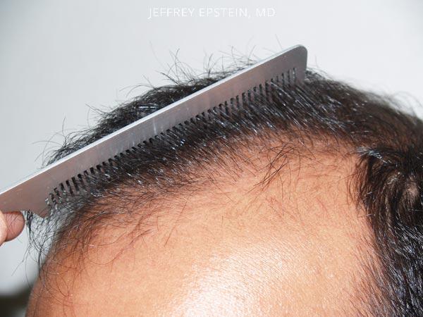 Hair Transplants for Men Before and after in Miami, FL, Paciente 38906