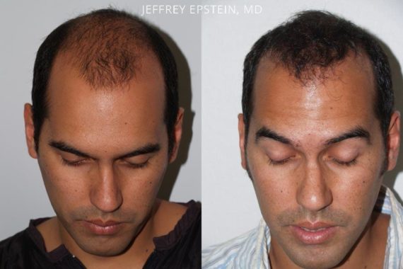 Trasplante de Pelo en Hombres Before and after in Miami, FL, Paciente 81965
