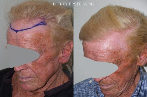 Trasplante de Pelo en Hombres Before and after in Miami, FL, Paciente 81934