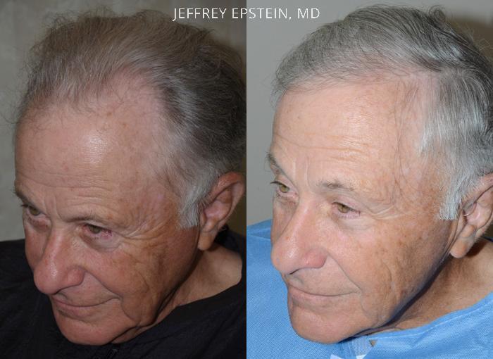 Hair Transplants for Men Before and after in Miami, FL, Paciente 38919