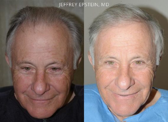 Trasplante de Pelo en Hombres Before and after in Miami, FL, Paciente 81903