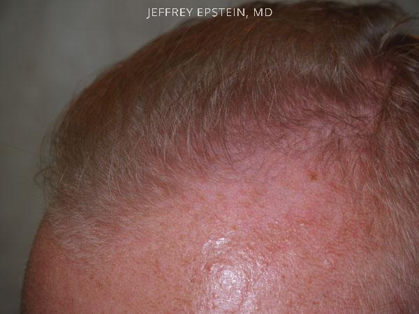 Hair Transplants for Men Before and after in Miami, FL, Paciente 38926
