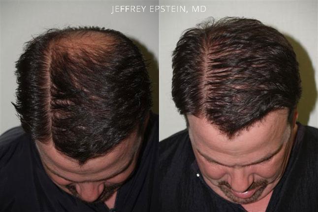 Hair Transplants for Men Before and after in Miami, FL, Paciente 38930
