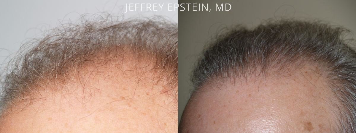 Hair Transplants for Men Before and after in Miami, FL, Paciente 38933