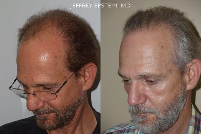 Trasplante de Pelo en Hombres Antes y después en Miami, FL, Paciente 81818