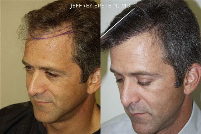 Hair Transplants for Men Before and after in Miami, FL, Paciente 38948