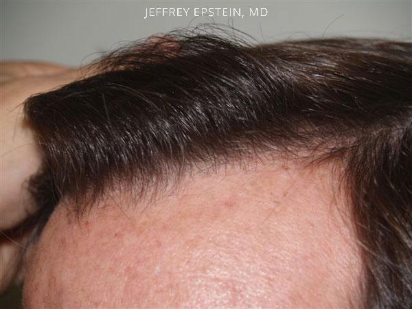 Hair Transplants for Men Before and after in Miami, FL, Paciente 38951