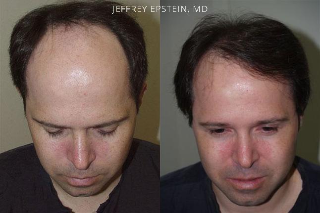 Hair Transplants for Men Before and after in Miami, FL, Paciente 38955