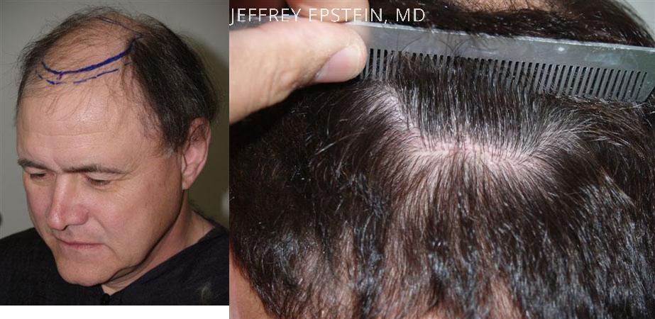 Hair Transplants for Men Before and after in Miami, FL, Paciente 38958