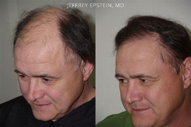 Hair Transplants for Men Before and after in Miami, FL, Paciente 38958
