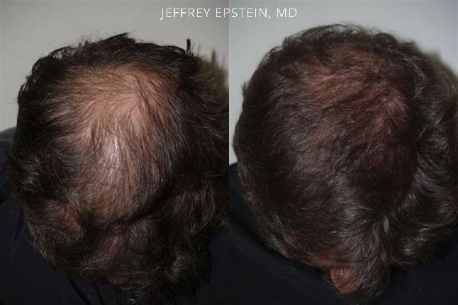 Hair Transplants for Men Before and after in Miami, FL, Paciente 38965