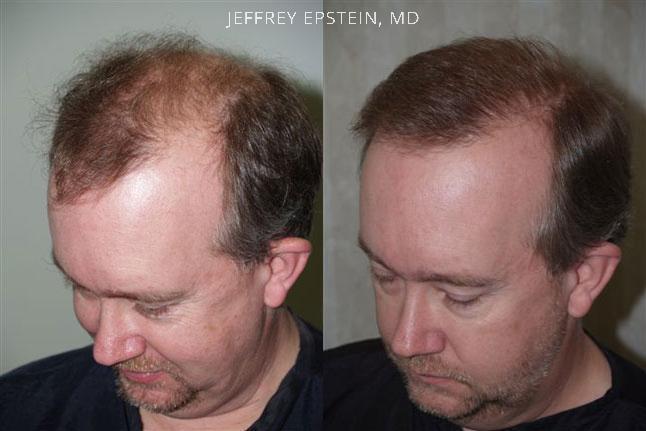 Hair Transplants for Men Before and after in Miami, FL, Paciente 38968