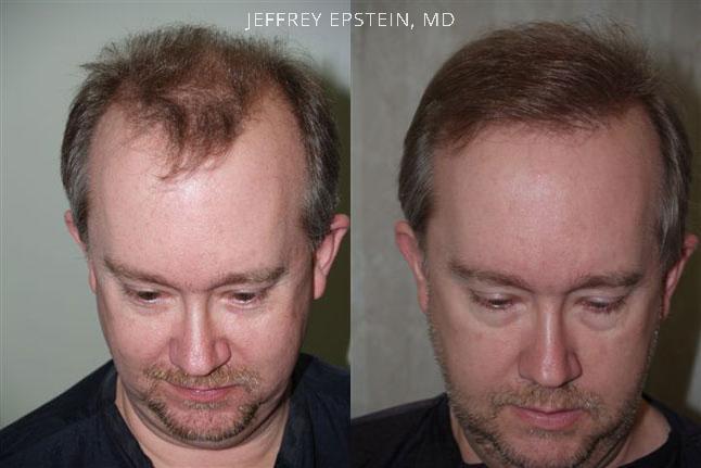 Hair Transplants for Men Before and after in Miami, FL, Paciente 38968