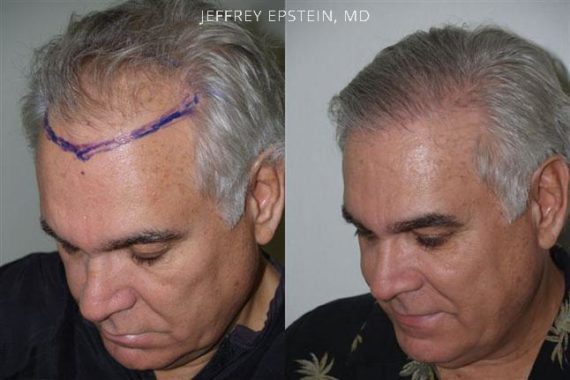 Trasplante de Pelo en Hombres Before and after in Miami, FL, Paciente 81586