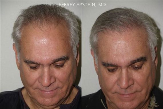 Trasplante de Pelo en Hombres Before and after in Miami, FL, Paciente 81586