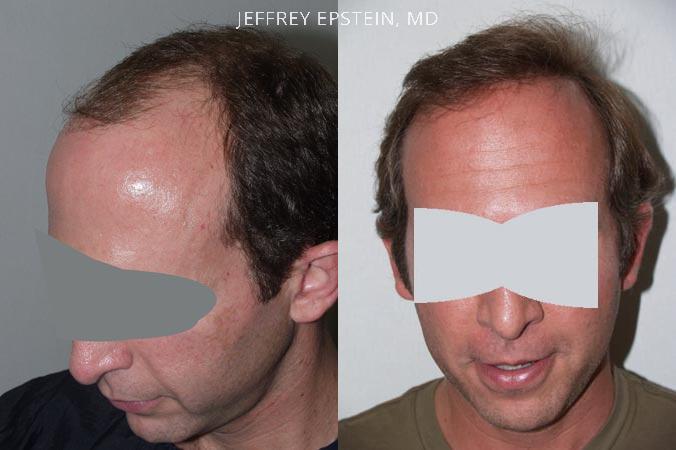 Hair Transplants for Men Before and after in Miami, FL, Paciente 38983