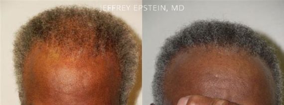 Trasplante de Pelo en Hombres Before and after in Miami, FL, Paciente 81536