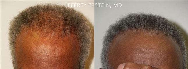 Hair Transplants for Men Before and after in Miami, FL, Paciente 38991