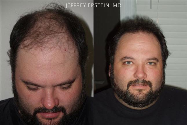 Hair Transplants for Men Before and after in Miami, FL, Paciente 38994