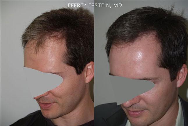 Hair Transplants for Men Before and after in Miami, FL, Paciente 38998