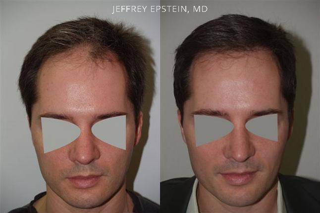 Hair Transplants for Men Before and after in Miami, FL, Paciente 38998