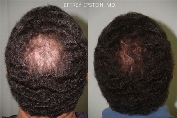 Trasplante de Pelo en Hombres Before and after in Miami, FL, Paciente 81473