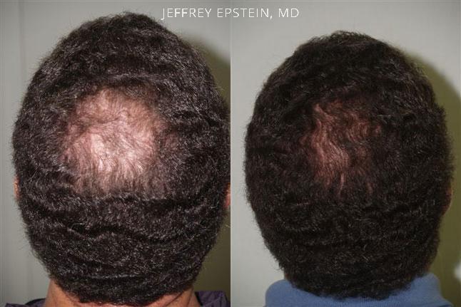 Hair Transplants for Men Before and after in Miami, FL, Paciente 39004
