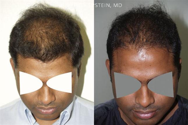 Hair Transplants for Men Before and after in Miami, FL, Paciente 39007