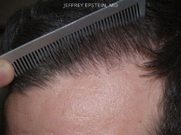 Hair Transplants for Men Before and after in Miami, FL, Paciente 39013