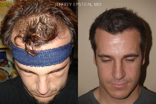 Hair Transplants for Men Before and after in Miami, FL, Paciente 39013