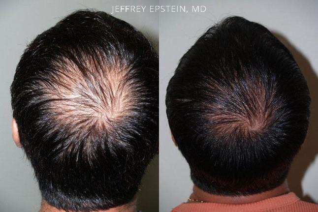 Hair Transplants for Men Before and after in Miami, FL, Paciente 39018